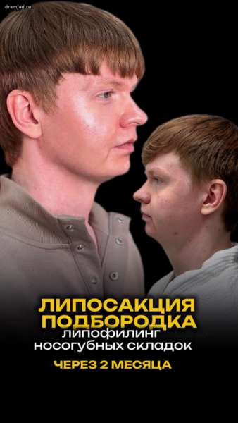 Мужская липосакция подбородка и липофилинг носогубных складок через 2 месяца (с фото- и видео-результатом)