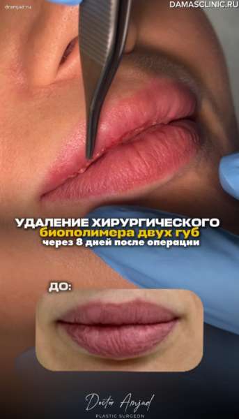 Удаление хирургического биополимера 2-х губ через 8 дней после операции. Как выглядят швы на губах?