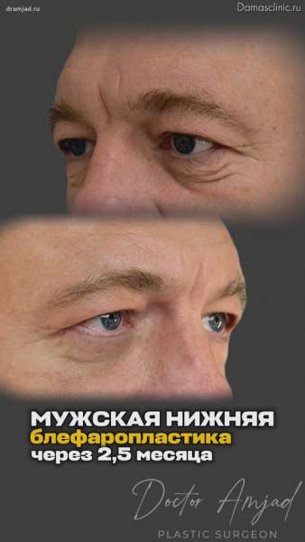 Мужская нижняя блефаропластика через 2,5 месяца с фото и видео результатом
