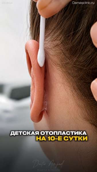Детская отопластика: до и на 10-е сутки после (с коррекцией лопоухости). Как выглядят швы?