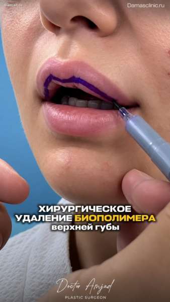 Как удаляют биополимер из губ хирургически. Фото швов сразу после