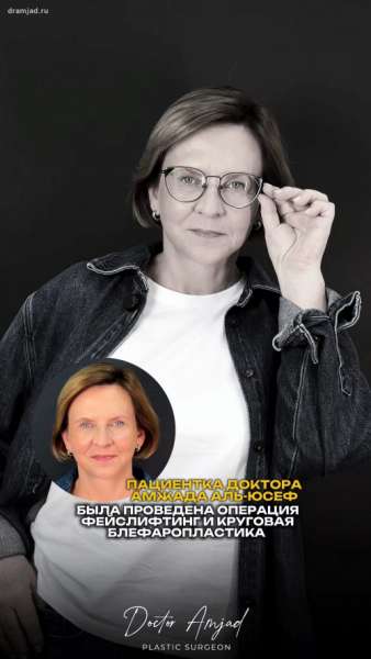 Фейслифтинг «Deep plane» + круговая блефаропластика через 3 месяца в отзыве пациентки