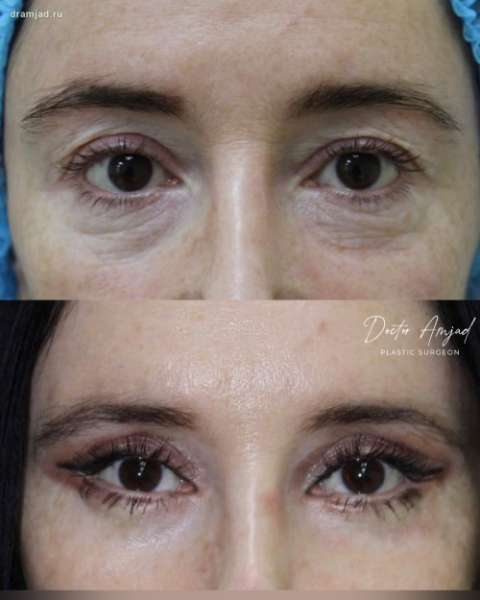 Круговая пластика век до и в период первичной реабилитации