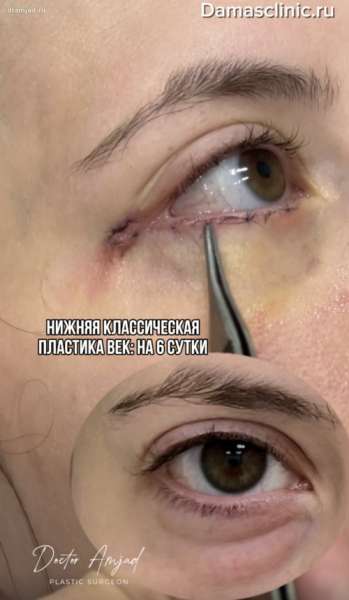 Как выглядят швы на нижнем веке при классической пластике на 6-е сутки в видео