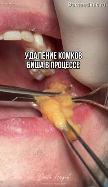 Удаление комков Биша мужчине в процессе в видео, с комментариями
