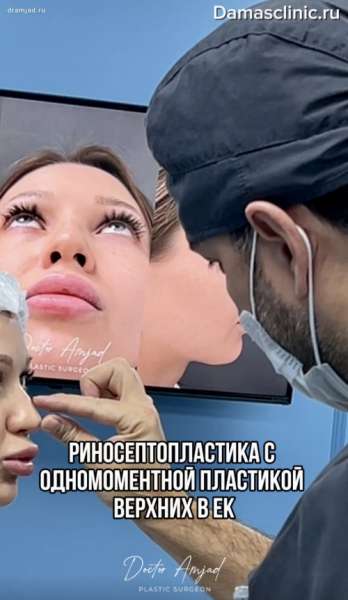 Риносептопластика, совмещенная с пластикой верхних век одномоментно. Видео результата