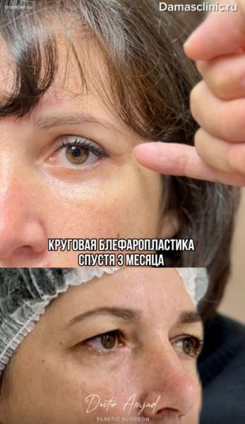 Верхняя и нижняя пластика век на плановом осмотре: фото и видео результаты