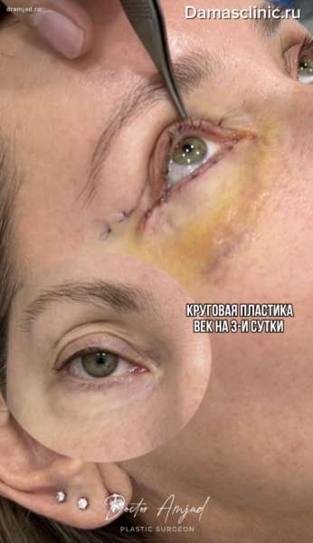 Как выглядят веки после круговой блефаропластики на 3-и сутки в видео с комментариями