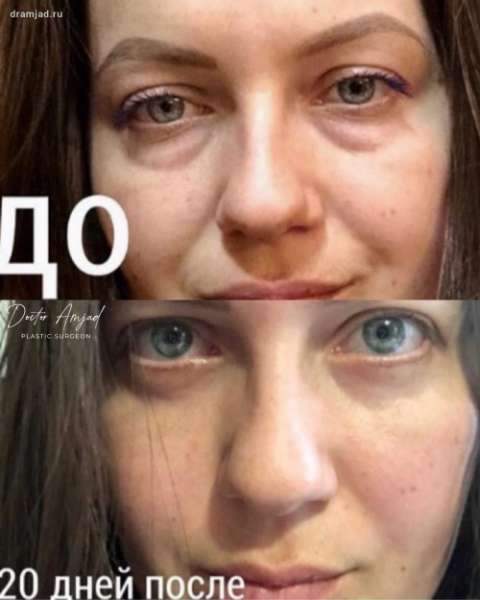 Нижняя классическая пластика век с фото-отзывами от пациентов