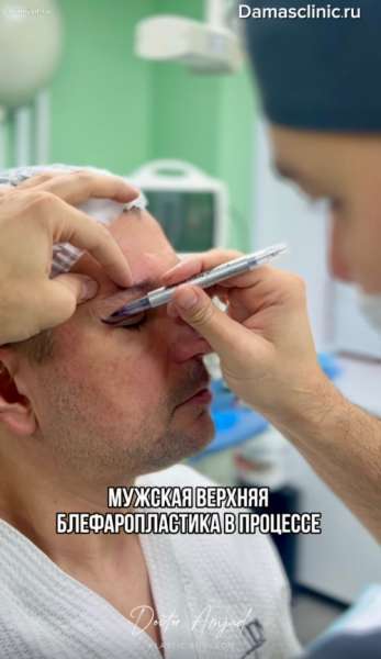 Мужская блефаропластика: вид наркоза, период реабилитации и фото результатов