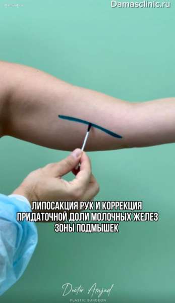 Липосакция рук и коррекция придаточной доли молочных желез зоны подмышек. Лифтинг подмышечной зоны