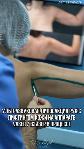 Ультразвуковая липосакция рук с лифтингом кожи на аппарате VASER / ВЭЙЗЕР в процессе