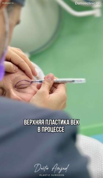 Верхняя пластика век в процессе с удалением избытка кожи и грыж