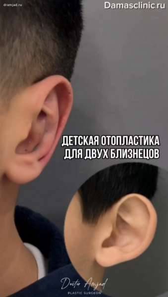 Детская отопластика для двух мальчиков-близнецов с видео и фото-результатами