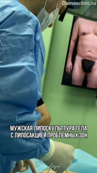 Мужская липоскульптура тела с липосакцией проблемных зон в процессе