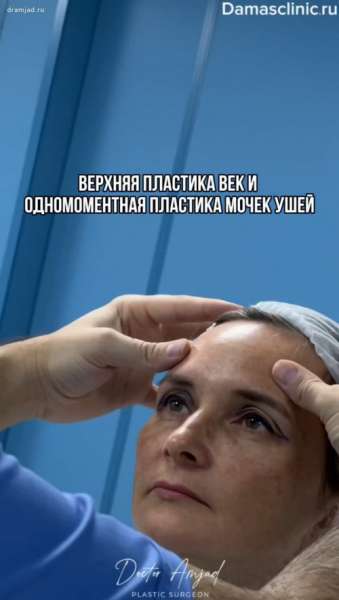 Верхняя пластика век и одномоментная пластика мочек в процессе
