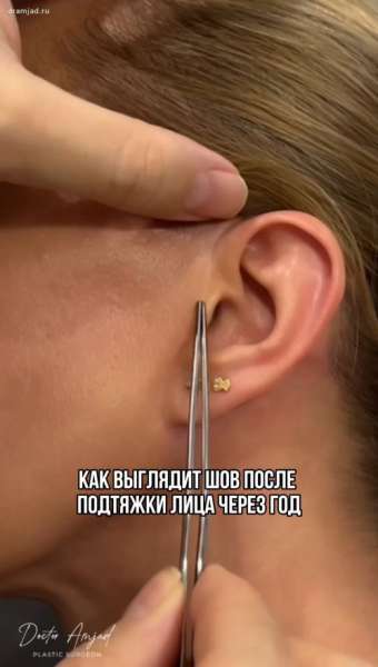 Как выглядит шов после подтяжки лица через год с видео и комментариями доктора