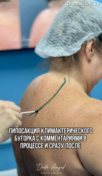 Липосакция климактерического бугорка с комментариями в процессе и с фото-результатами сразу после