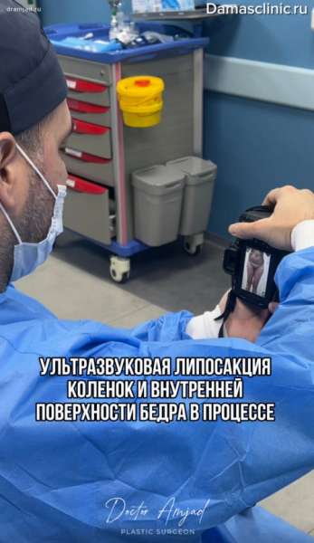 Ультразвуковая липосакция коленок и внутренней поверхности бедра в процессе