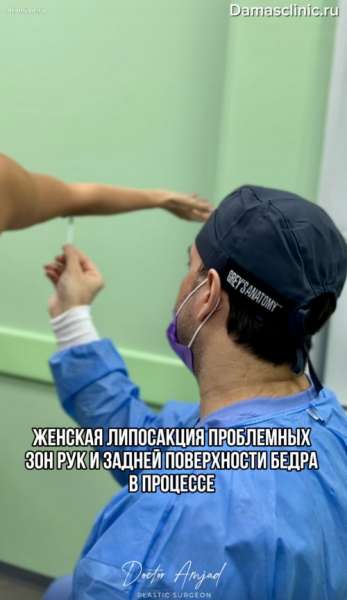 Женская липосакция проблемных зон: рук и задней поверхности бедер в процессе