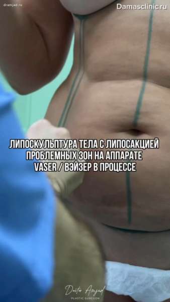 Липоскульптура тела с липосакцией проблемных зон на аппарате VASER / ВЭЙЗЕР в процессе с фото- и видео-результатами