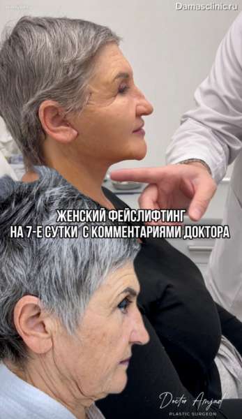 Женский фейслифтинг на 7-е сутки с комментариями доктора с видео-результатом