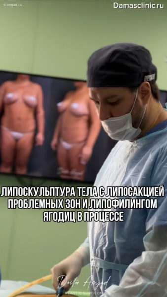 Липоскульптура тела с липосакцией проблемных зон и липофилингом ягодиц в процессе и с фото-результатами сразу после