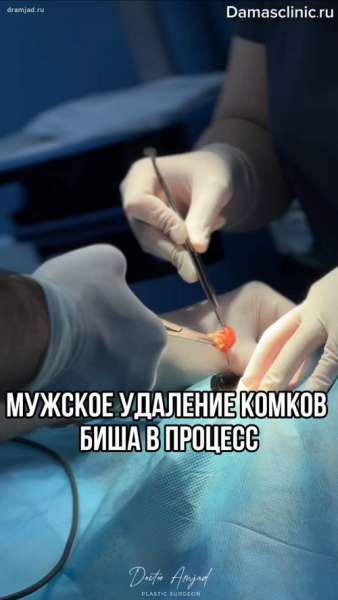 Мужское удаление комков Биша в процессе в видео