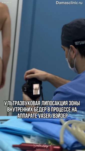 Ультразвуковая липосакция зоны внутренних бедер в процессе на аппарате VASER / ВЭЙЗЕР. Фото результатов