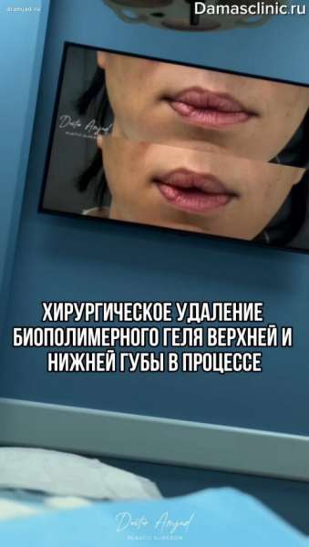 Хирургическое удаление биополимерного геля верхней и нижней губы в процессе. Виды удаления биополимерного геля из губ