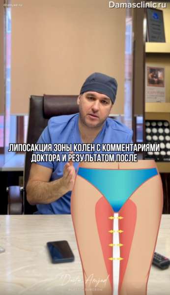 Липосакция внутренних бедер и зоны колен в процессе и с фото-результатом сразу после
