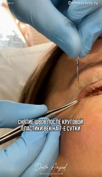 Снятие швов после круговой пластики век на 7-е сутки. Как выглядят веки сразу после снятия швов (с фото-результатами)