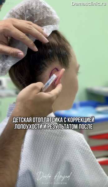 Детская отопластика с коррекцией лопоухости с фото-результатами