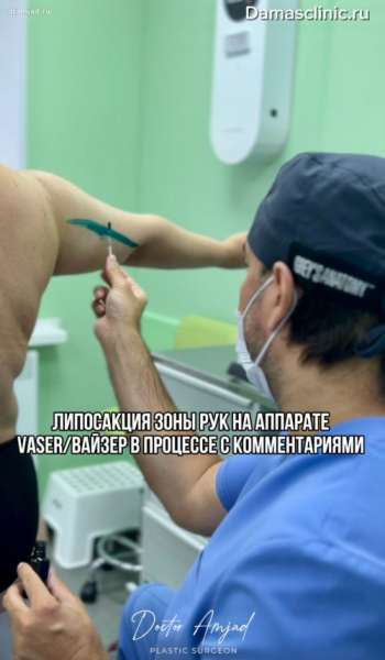 Липосакция зоны рук на аппарате VASER / ВАЙЗЕР в процессе, с комментариями и фото-результатами