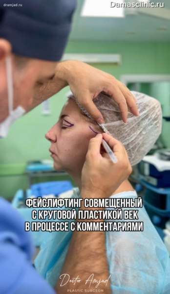 Фейслифтинг, совмещенный с круговой пластикой век, в процессе с комментариями и фото-результатами