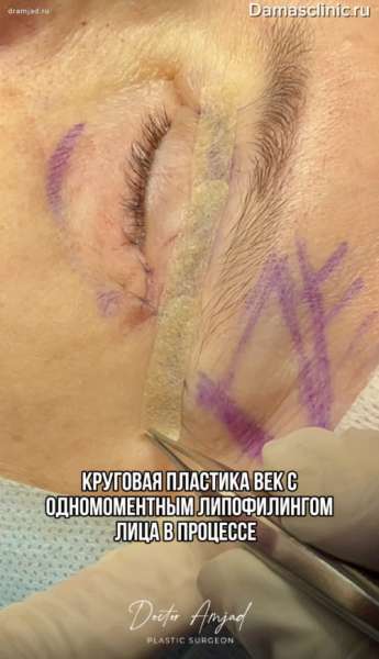 Круговая пластика век с одномоментным липофилингом лица в процессе и с фото-результатами