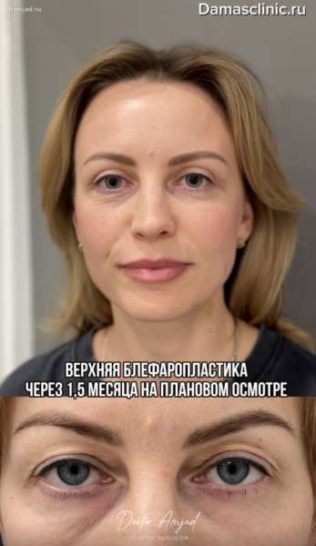 Верхняя блефаропластика через 1,5 месяца с видео-результатом и отзывом пациентки