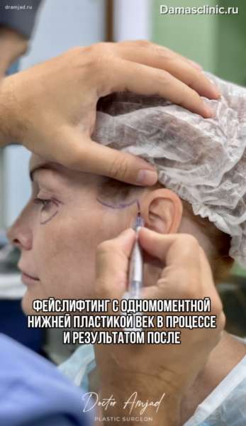 Фейслифтинг с одномоментной нижней пластикой век: в процессе и с фото-результатом после