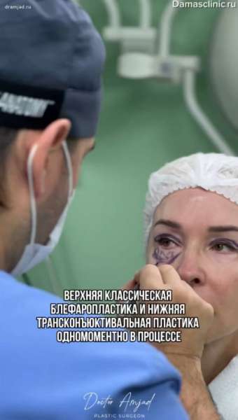 Верхняя классическая блефаропластика и нижняя трансконъюнктивальная пластика одномоментно в процессе с видео