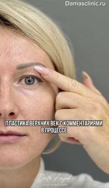 Пластика верхних век с комментариями в процессе: показания и результаты