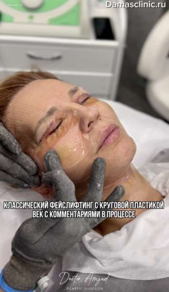 Фейслифтинг + круговая пластика век: в процессе и на 3-и сутки. Сеанс ускоренной реабилитации