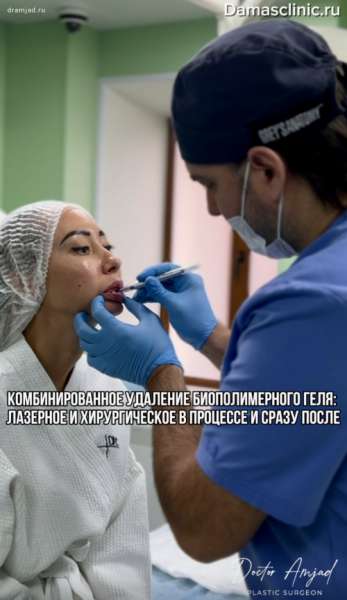 Комбинированное удаление биополимерного геля - лазерное и хирургическое - в процессе и сразу после. Фото результатов