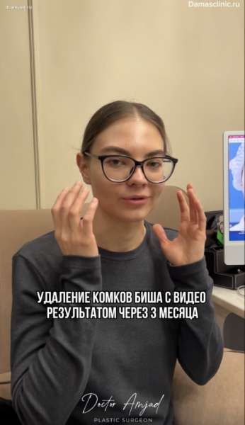 Удаление комков Биша с видео и фото-результатом. Отзыв пациентки. Показания и противопоказания