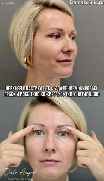 Верхняя пластика век с удалением жировых грыж и избытков кожи: 6-е сутки, снятие швов. Как выглядят швы после пластики век