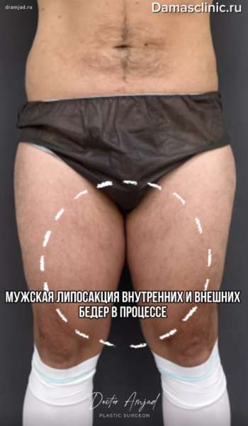 Мужская липосакция внутренних и внешних бедер в процессе. Фото и видео результатов мужской липосакции