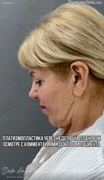 Платизмопластика через неделю на плановом осмотре с комментариями доктора и пациента. Фото и видео результатов