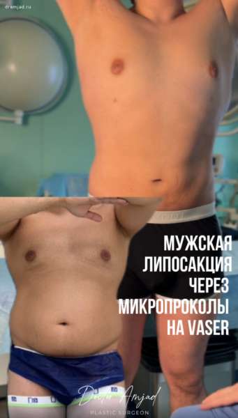 Результат мужской Vaser-липосакции без разрезов - через микропроколы с видео