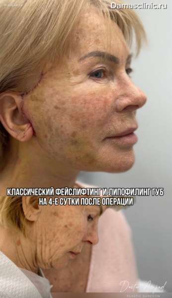 Классический фейслифтинг и липофилинг губ на 4-е сутки после операции. Отзыв пациентки и видео результата