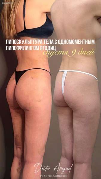 Липоскульптура тела с одномоментным липофилингом ягодиц спустя 9 дней с фото- и видео-результатами. Vaser – липоскульптура